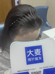-大麦微针植发全国连锁