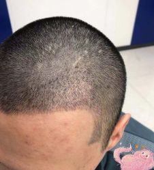 -大麦微针植发丨全国连锁