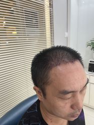 -大麦微针植发丨全国连锁