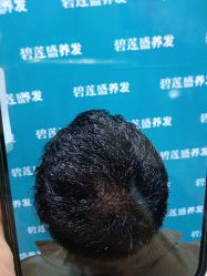 -碧莲盛·不剃发植发