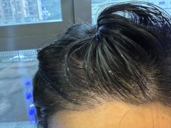 -碧莲盛·不剃发植发