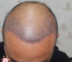 -大麦微针植发丨全国连锁