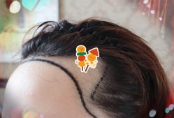 -大麦微针植发全国连锁