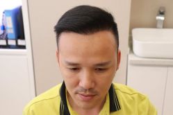 -大麦微针植发丨全国连锁
