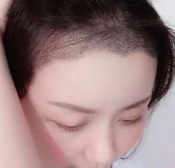 -大麦微针植发全国连锁