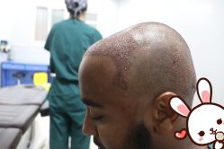 点击看大图 -大麦微针植发丨全国连锁