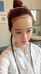 -大麦微针植发丨全国连锁