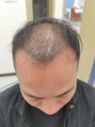 体验后-大麦微针植发全国连锁