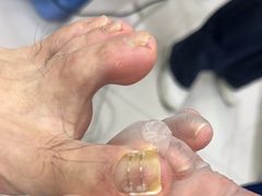 -Andrew指甲专科灰指甲·甲沟炎矫正·3D步态矫形鞋垫定制(浦三路店)
