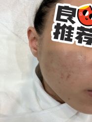 体验后-郡艺医疗美容·微整·眼鼻吸脂