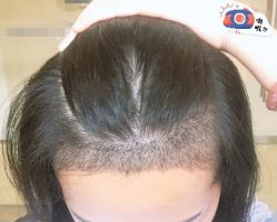 -大麦微针植发丨全国连锁