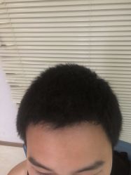 -大麦微针植发丨全国连锁