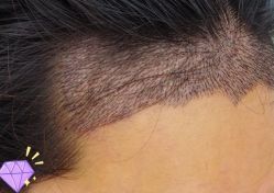 -大麦微针植发丨全国连锁