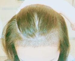 -大麦微针植发丨全国连锁