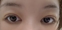 体验后-苏州维多利亚美容医院