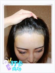 点击看大图 体验后-大麦微针植发全国连锁