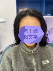 -大麦微针植发全国连锁