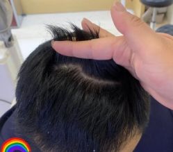 -大麦微针植发丨全国连锁