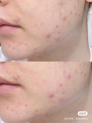 -苗方清颜痘肌研究所