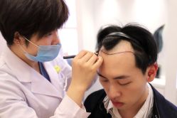 -大麦微针植发丨全国连锁