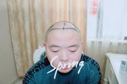 点击看大图 体验后-大麦微针植发全国连锁