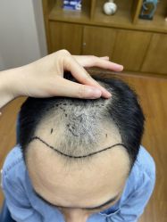 体验前-大麦微针植发全国连锁