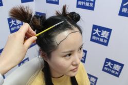 -大麦微针植发丨全国连锁
