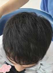 -大麦微针植发丨全国连锁