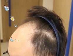 -大麦微针植发全国连锁