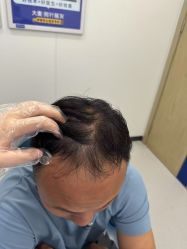点击看大图 -大麦微针植发全国连锁