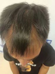 -大麦微针植发丨全国连锁