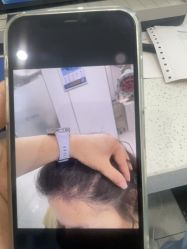 -大麦微针植发丨全国连锁