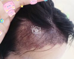 -大麦微针植发全国连锁