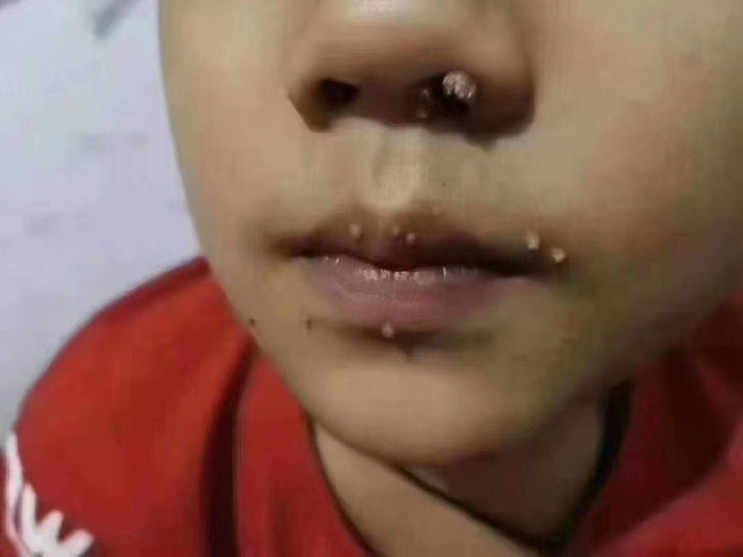 小朋友也会被传染,有疣的家长一定要定时自