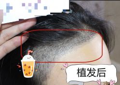 -大麦微针植发全国连锁