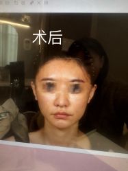 体验后-杭州米兰柏羽医疗美容医院