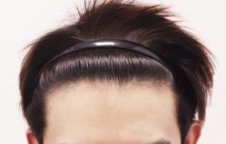 -大麦微针植发全国连锁