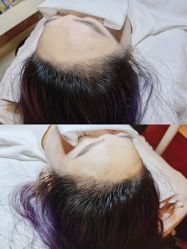 点击看大图 -西施无菌半永久纹绣眉眼影唇轻增发纹发际线