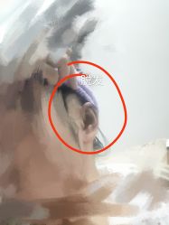 体验后-正璞医疗美容·皮肤修复·微整注射