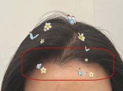 -大麦微针植发全国连锁