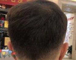 点击看大图 -大麦微针植发全国连锁