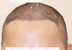 -大麦微针植发全国连锁