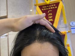 -大麦微针植发全国连锁