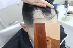 -大麦微针植发全国连锁