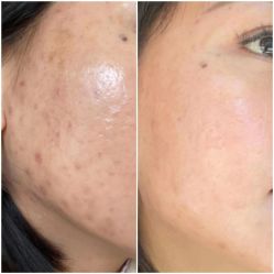 体验前-瓷肌博士·祛痘科技美肤