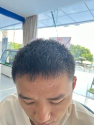 -大麦微针植发全国连锁