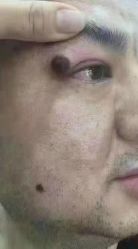 -北京美痣堂古方祛痣斑疣瘊