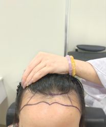 -碧莲盛·不剃发植发