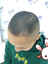 -大麦微针植发丨全国连锁