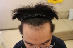 -大麦微针植发丨全国连锁